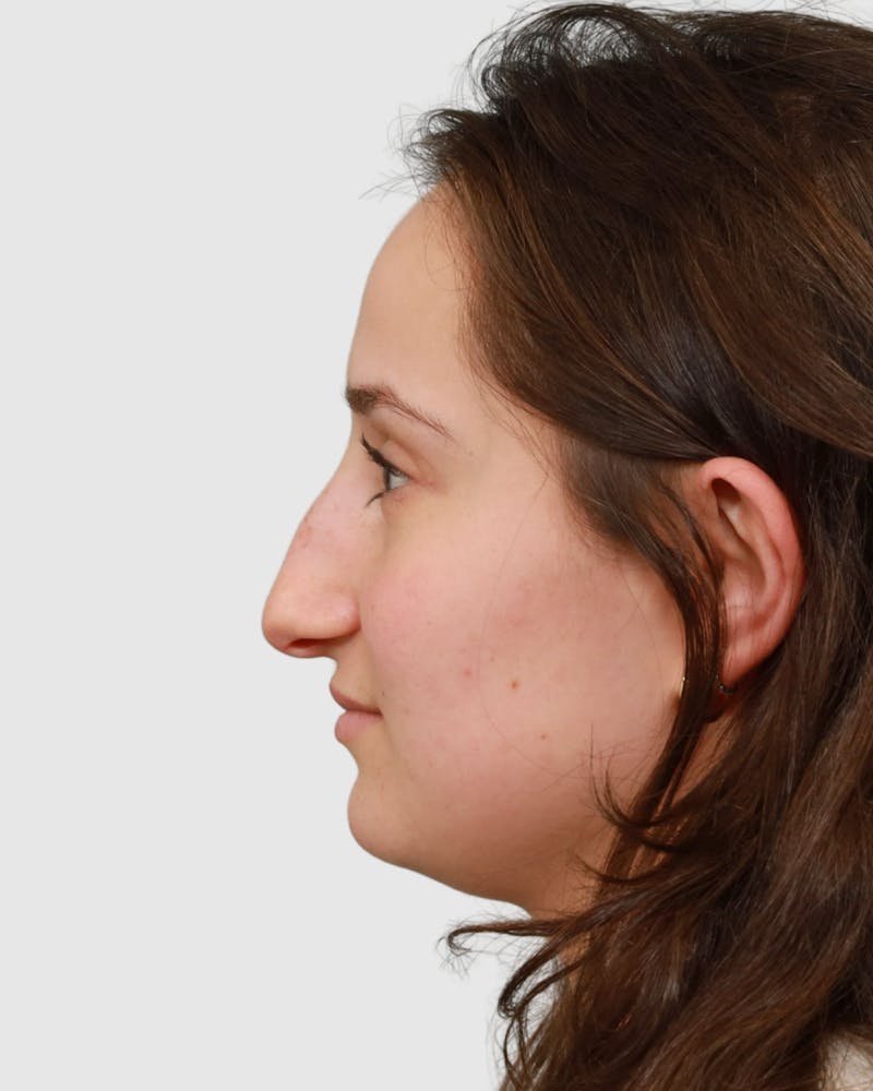 Rhinoplasty Before & After Gallery - Patient 182401 - Image 9
