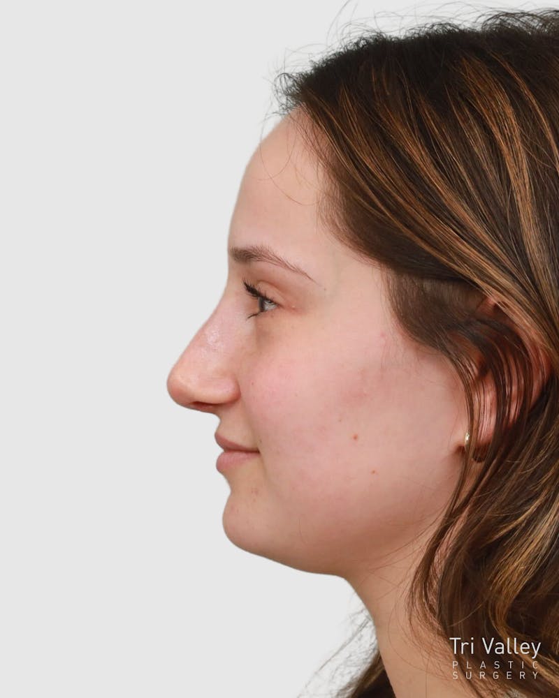 Rhinoplasty Before & After Gallery - Patient 182401 - Image 10