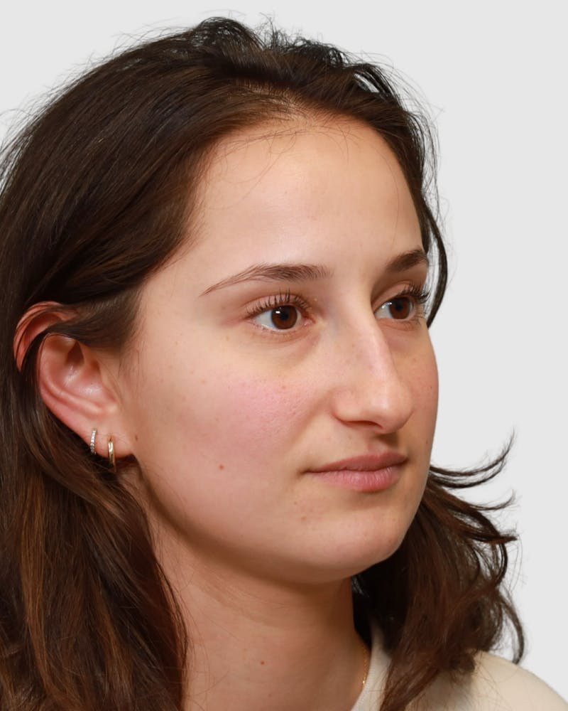 Rhinoplasty Before & After Gallery - Patient 182401 - Image 5