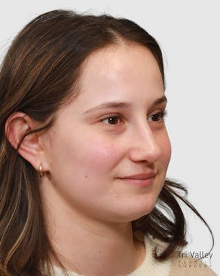 Rhinoplasty Before & After Gallery - Patient 182401 - Image 6