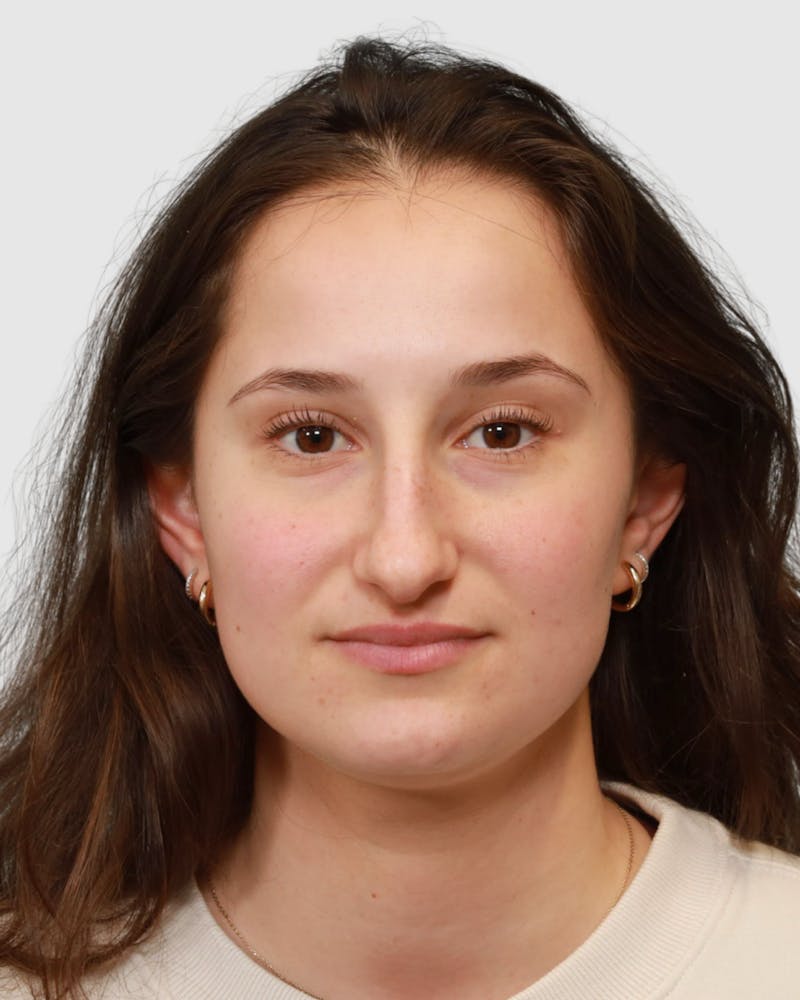 Rhinoplasty Before & After Gallery - Patient 182401 - Image 3