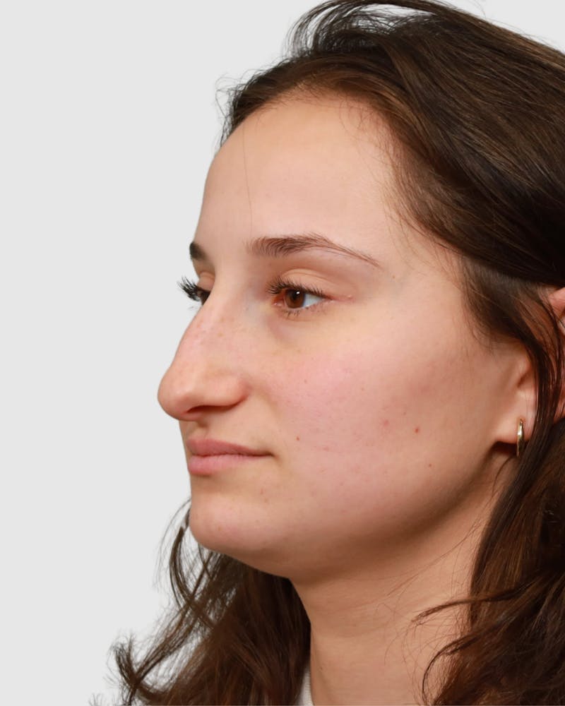 Rhinoplasty Before & After Gallery - Patient 182401 - Image 7
