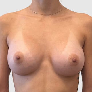 Breast Augmentation Before & After Gallery - Patient 369965 - Image 2