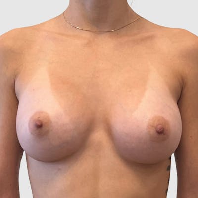 Breast Augmentation Before & After Gallery - Patient 369965 - Image 2