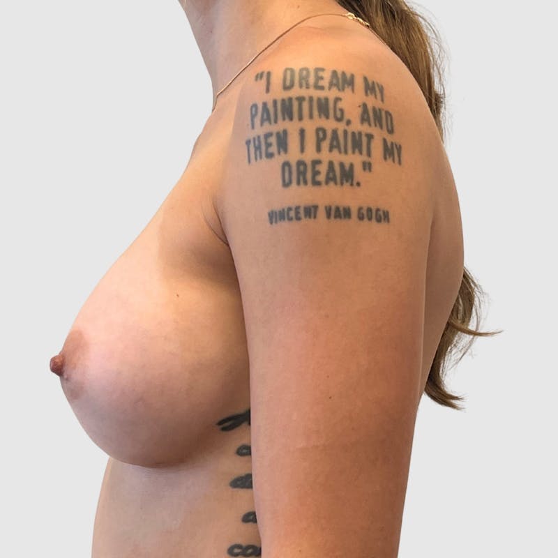 Breast Augmentation Before & After Gallery - Patient 369965 - Image 6