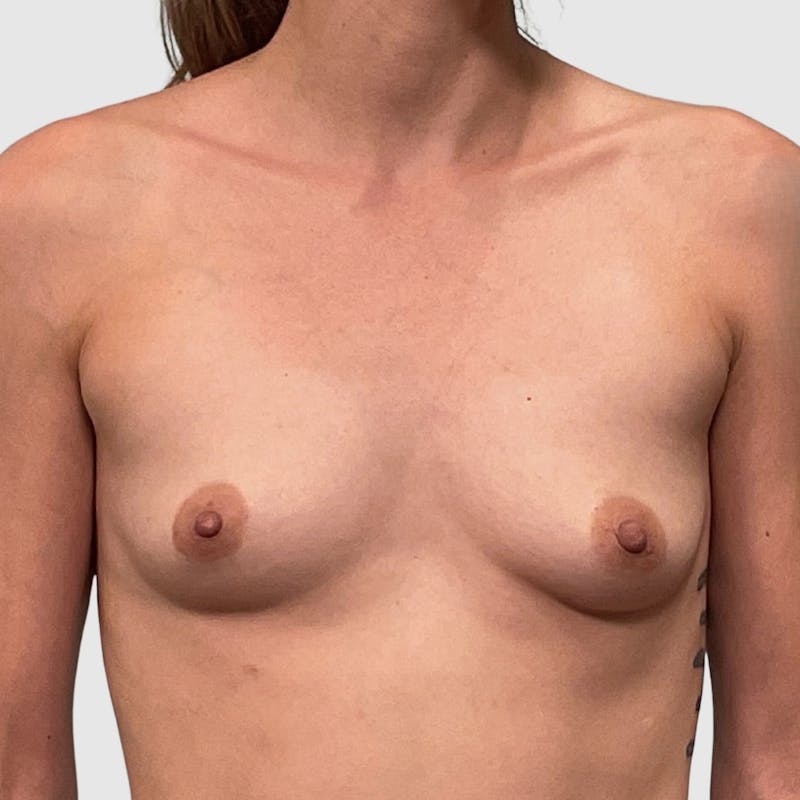 Breast Augmentation Before & After Gallery - Patient 369965 - Image 1