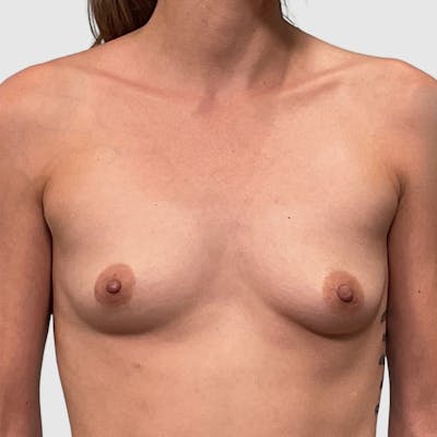 Breast Augmentation Before & After Gallery - Patient 369965 - Image 1