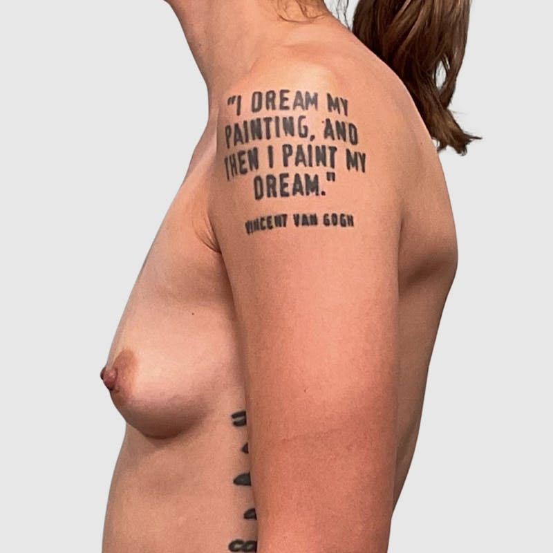 Breast Augmentation Before & After Gallery - Patient 369965 - Image 5