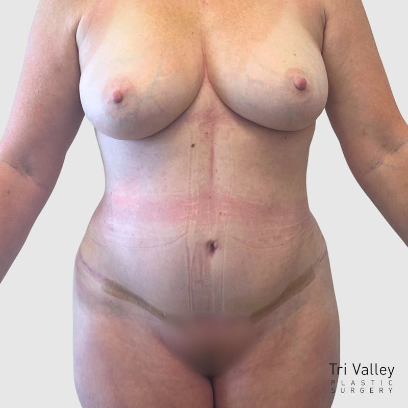 Tummy Tuck Before & After Gallery - Patient 363842 - Image 2