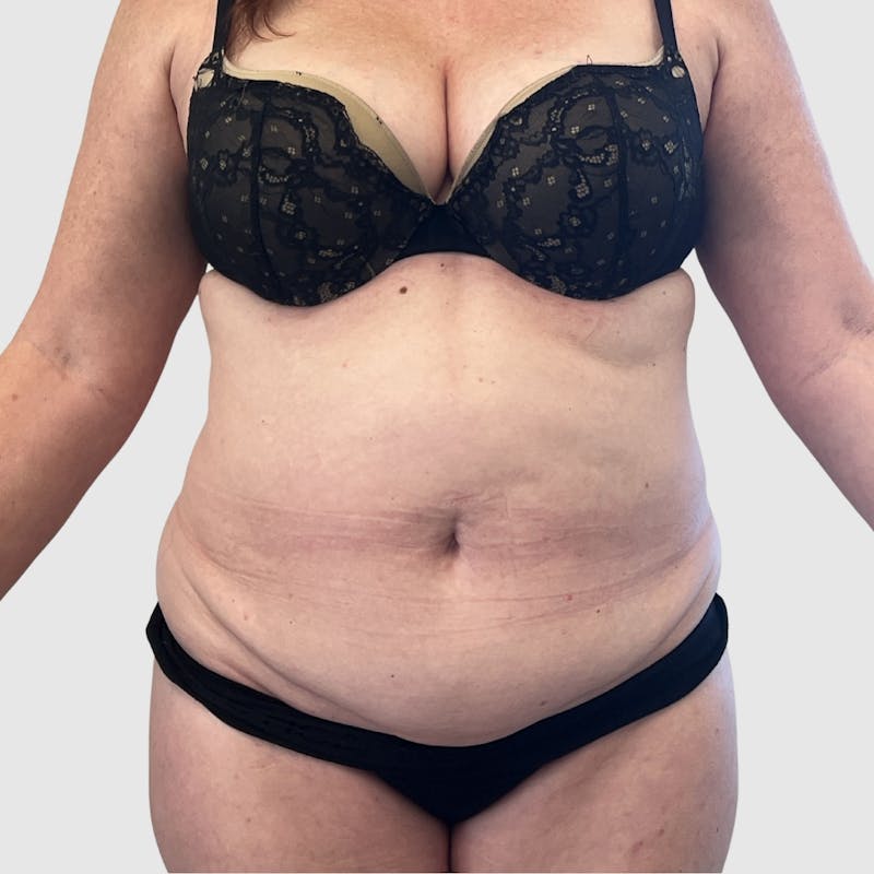 Tummy Tuck Before & After Gallery - Patient 363842 - Image 1