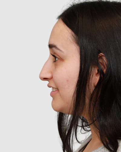 Rhinoplasty Before & After Gallery - Patient 167595 - Image 1
