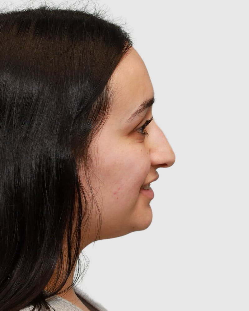 Rhinoplasty Before & After Gallery - Patient 167595 - Image 7