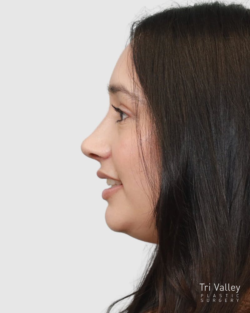 Rhinoplasty Before & After Gallery - Patient 167595 - Image 2