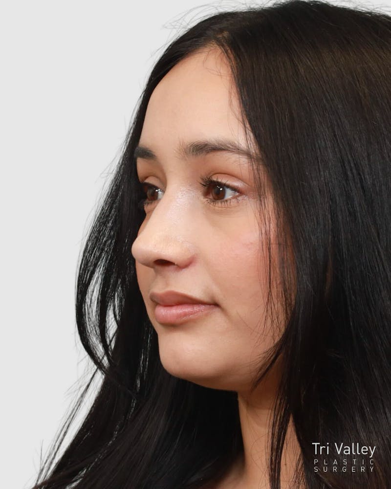Rhinoplasty Before & After Gallery - Patient 167595 - Image 4