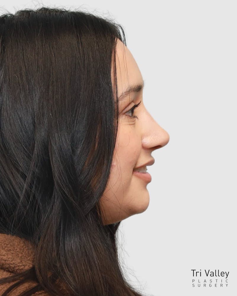 Rhinoplasty Before & After Gallery - Patient 167595 - Image 8