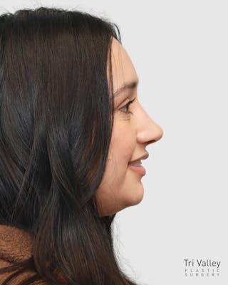 Rhinoplasty Before & After Gallery - Patient 167595 - Image 8