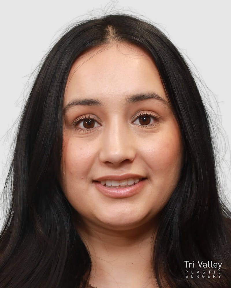 Rhinoplasty Before & After Gallery - Patient 167595 - Image 6