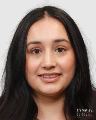 Rhinoplasty Before & After Gallery - Patient 167595 - Image 6