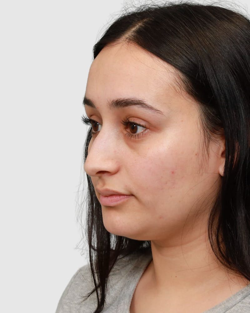 Rhinoplasty Before & After Gallery - Patient 167595 - Image 3