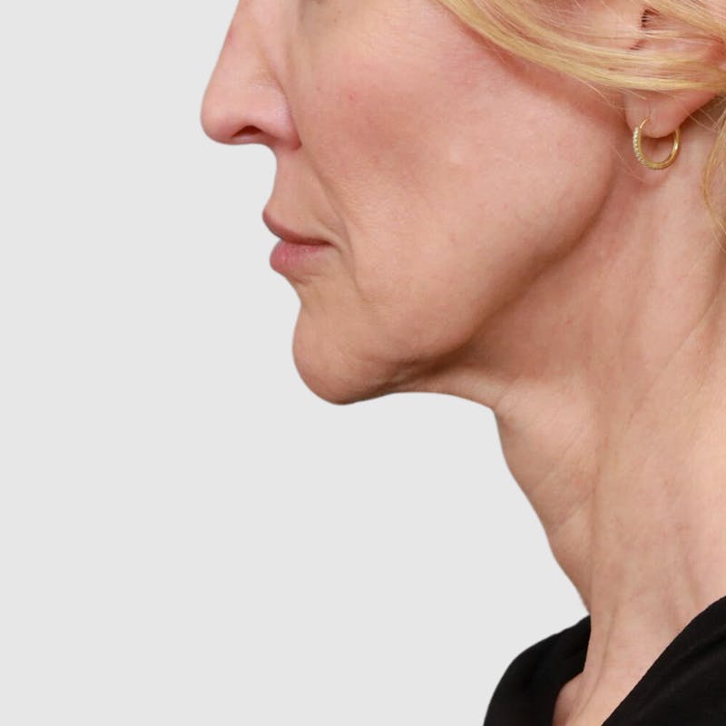 Face and Neck Lifts Before & After Gallery - Patient 189145 - Image 3