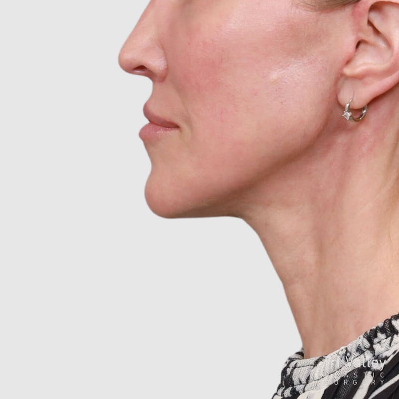 Face and Neck Lifts Before & After Gallery - Patient 189145 - Image 4