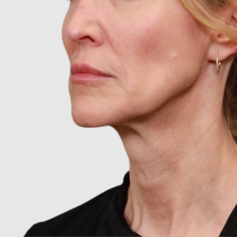Face and Neck Lifts Before & After Gallery - Patient 189145 - Image 1
