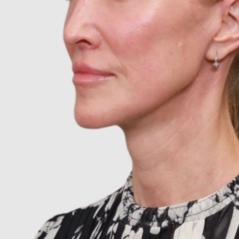 Face and Neck Lifts Before & After Gallery - Patient 189145 - Image 2
