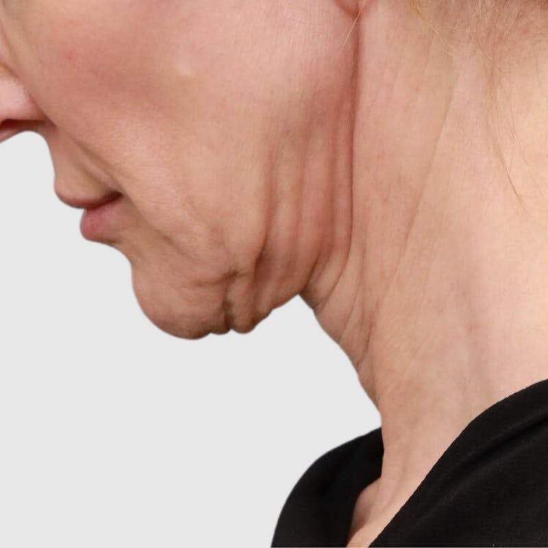 Face and Neck Lifts Before & After Gallery - Patient 189145 - Image 5