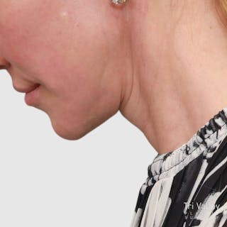 Face and Neck Lifts Before & After Gallery - Patient 189145 - Image 6