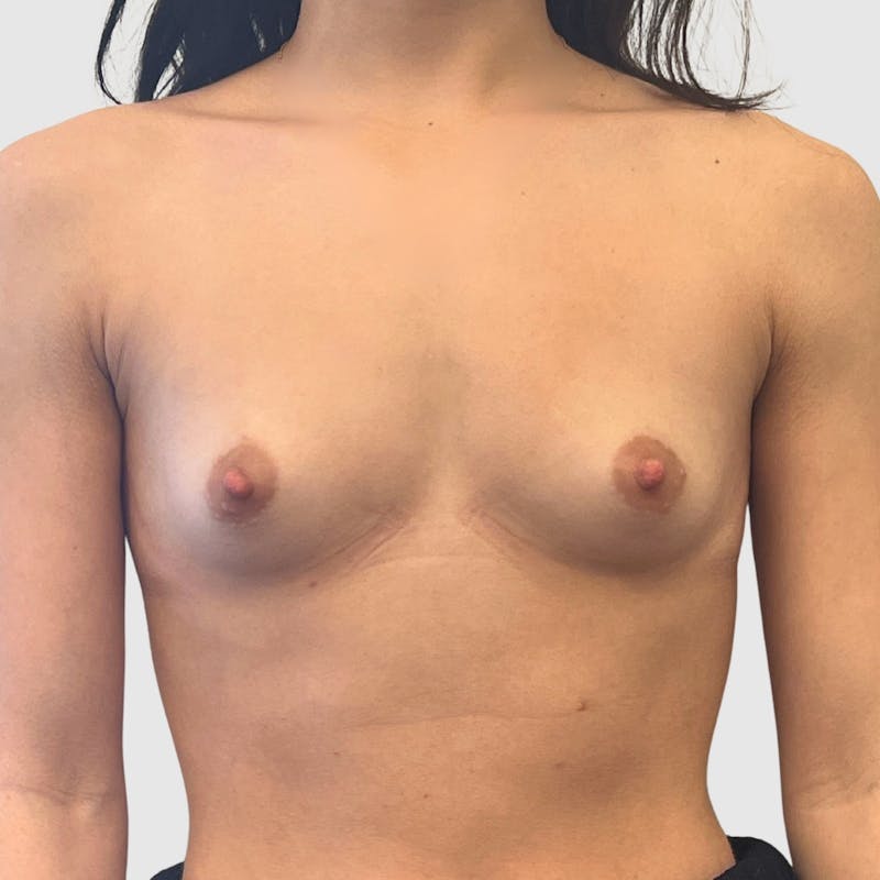 Breast Augmentation Before & After Gallery - Patient 230002 - Image 1