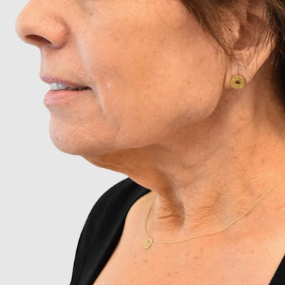 Face and Neck Lifts Before & After Gallery - Patient 202693 - Image 1