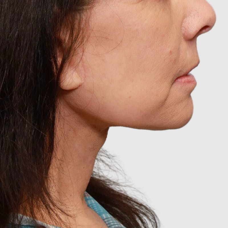 Face and Neck Lifts Before & After Gallery - Patient 202693 - Image 4