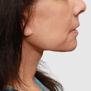 Face and Neck Lifts Before & After Gallery - Patient 202693 - Image 4