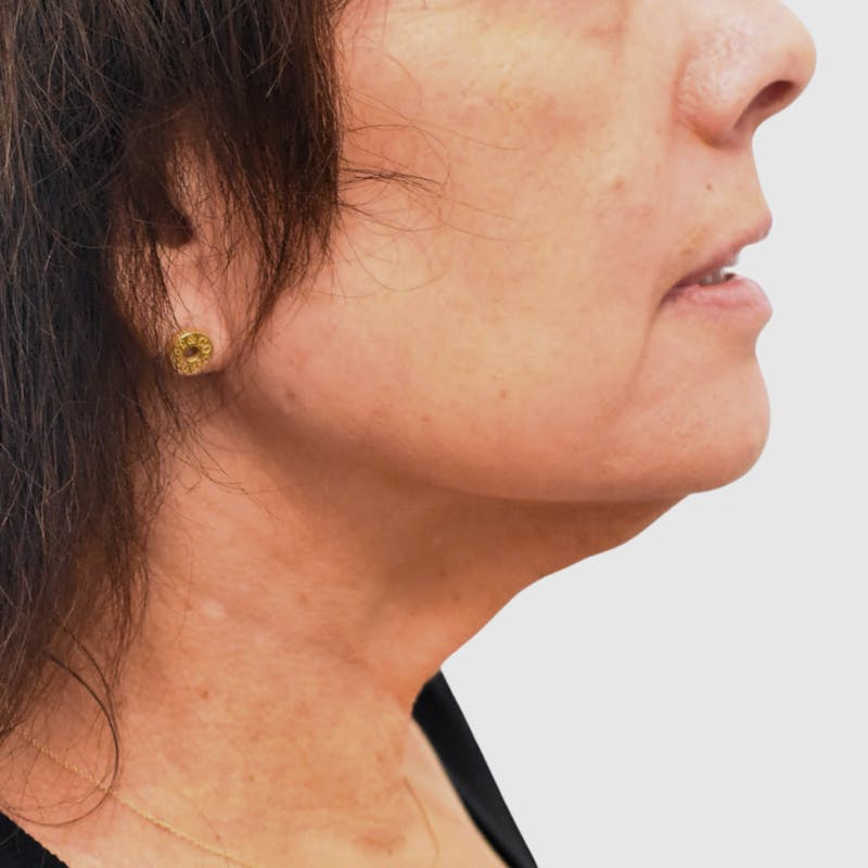 Face and Neck Lifts Before & After Gallery - Patient 202693 - Image 3