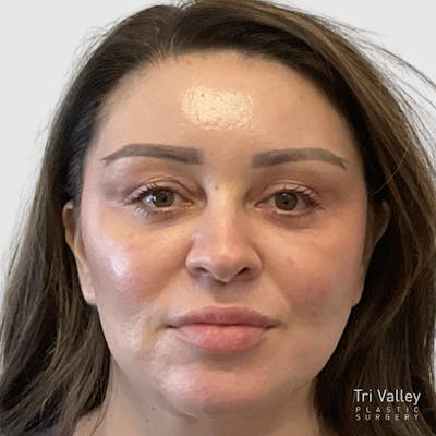 Blepharoplasty Before & After Gallery - Patient 249281 - Image 2