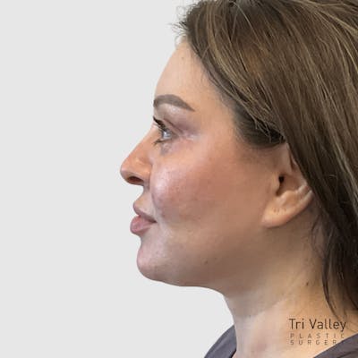 Face and Neck Lifts Before & After Gallery - Patient 219934 - Image 2