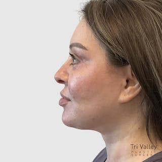 Face and Neck Lifts Before & After Gallery - Patient 219934 - Image 2