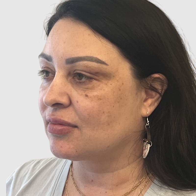 Face and Neck Lifts Before & After Gallery - Patient 219934 - Image 5