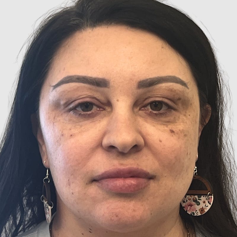 Face and Neck Lifts Before & After Gallery - Patient 219934 - Image 7