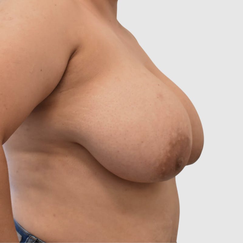 Breast Reduction Before & After Gallery - Patient 413755 - Image 3