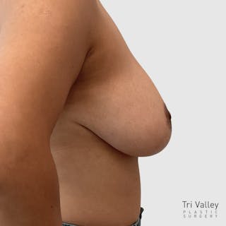 Breast Reduction Before & After Gallery - Patient 413755 - Image 4