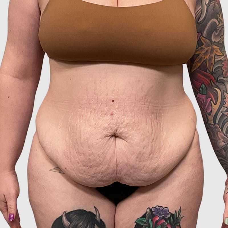 Tummy Tuck Before & After Gallery - Patient 237321 - Image 1
