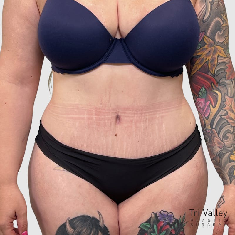 Tummy Tuck Before & After Gallery - Patient 237321 - Image 2