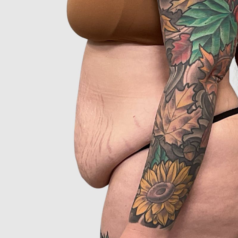 Tummy Tuck Before & After Gallery - Patient 237321 - Image 5