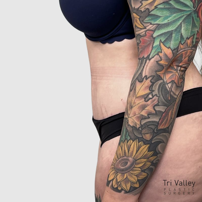 Tummy Tuck Before & After Gallery - Patient 237321 - Image 6
