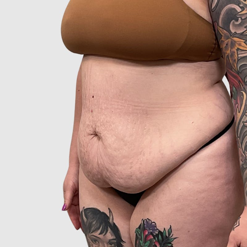 Tummy Tuck Before & After Gallery - Patient 237321 - Image 3