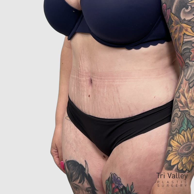 Tummy Tuck Before & After Gallery - Patient 237321 - Image 4