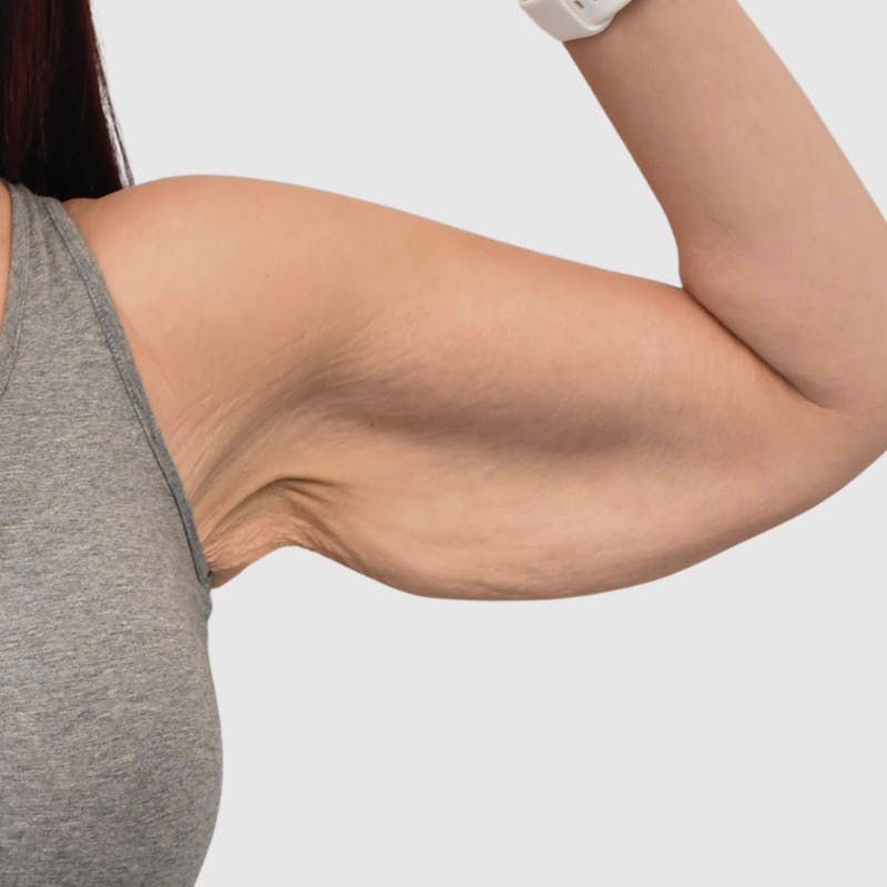 Brachioplasty Before & After Gallery - Patient 172094 - Image 1