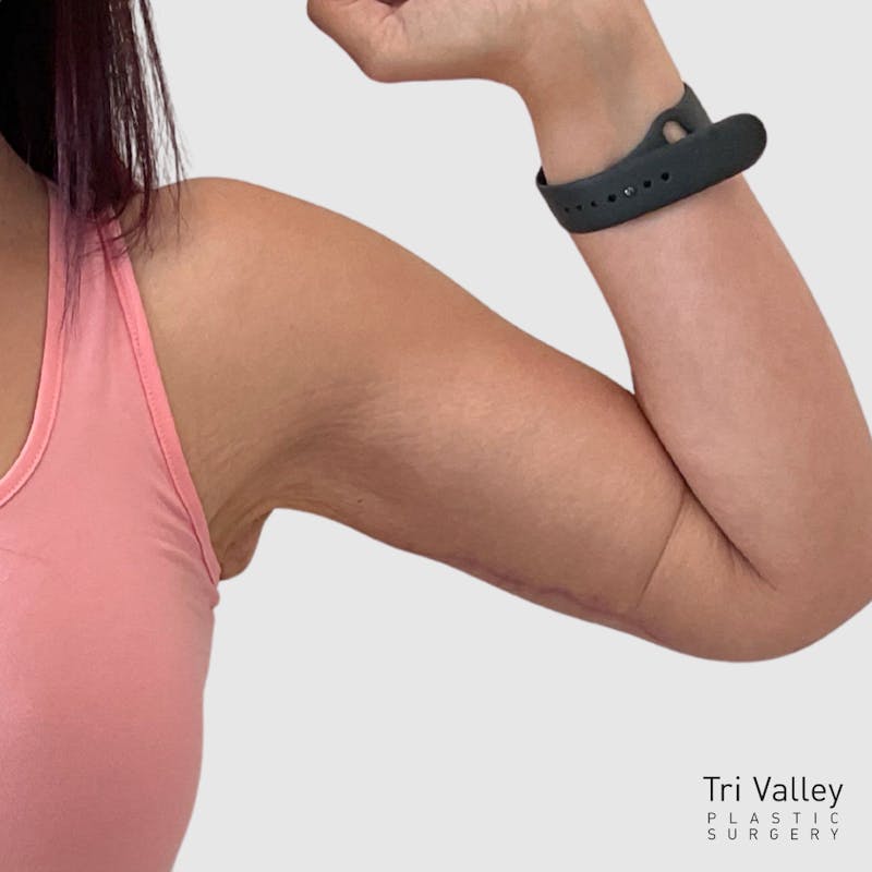 Brachioplasty Before & After Gallery - Patient 172094 - Image 2