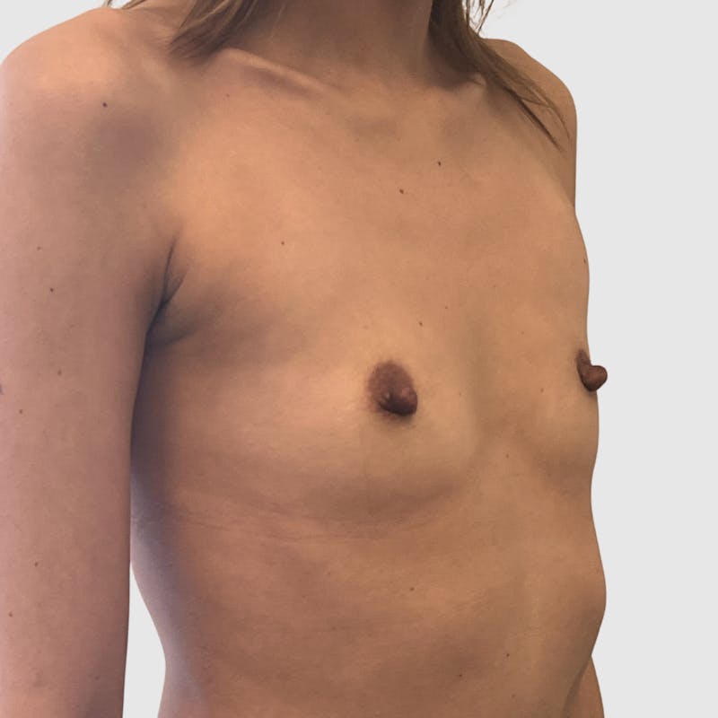 Breast Augmentation Before & After Gallery - Patient 338518 - Image 3